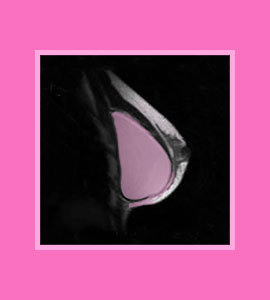breast-implant-mammography-1