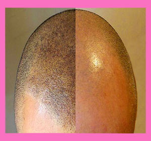 scalp-micropigmentation-1a