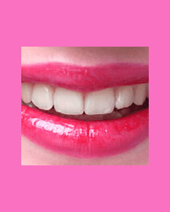 tooth-veneers-1